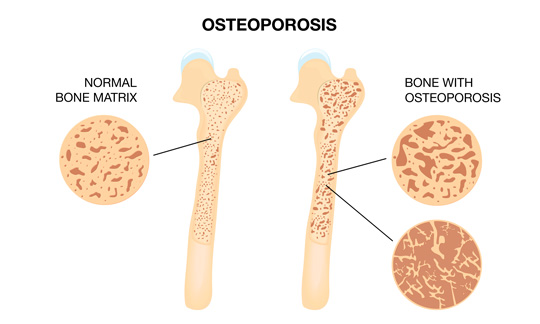 osteoporosis-01-540x324px-skincollagen-com.jpg