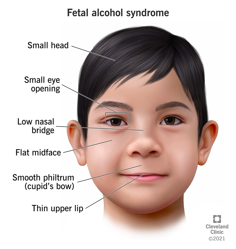 The Effects Of Fetal Alcohol Syndrome - Ask The Nurse Expert