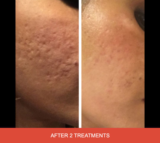 How Acne Scar Microneedling Can Fade Scars for Good | MDPen Skincare