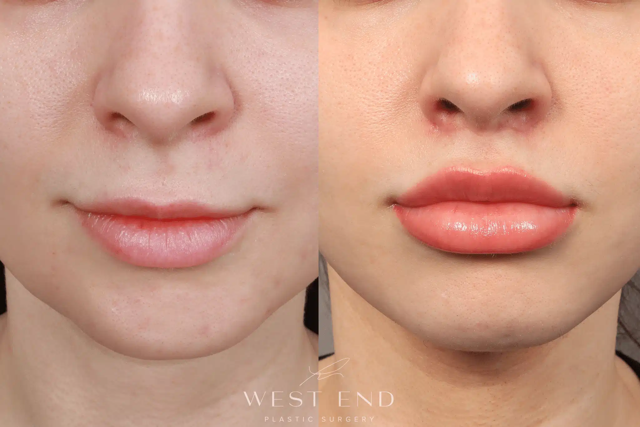 Lip Lift - West End Plastic Surgery