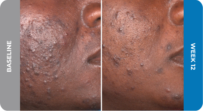 Winlevi Patient Results For Females new1