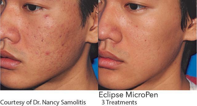 Microneedling PRP for Acne Scars: What to Expect