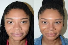 Wide Nose Rhinoplasty: a Surgery to ...