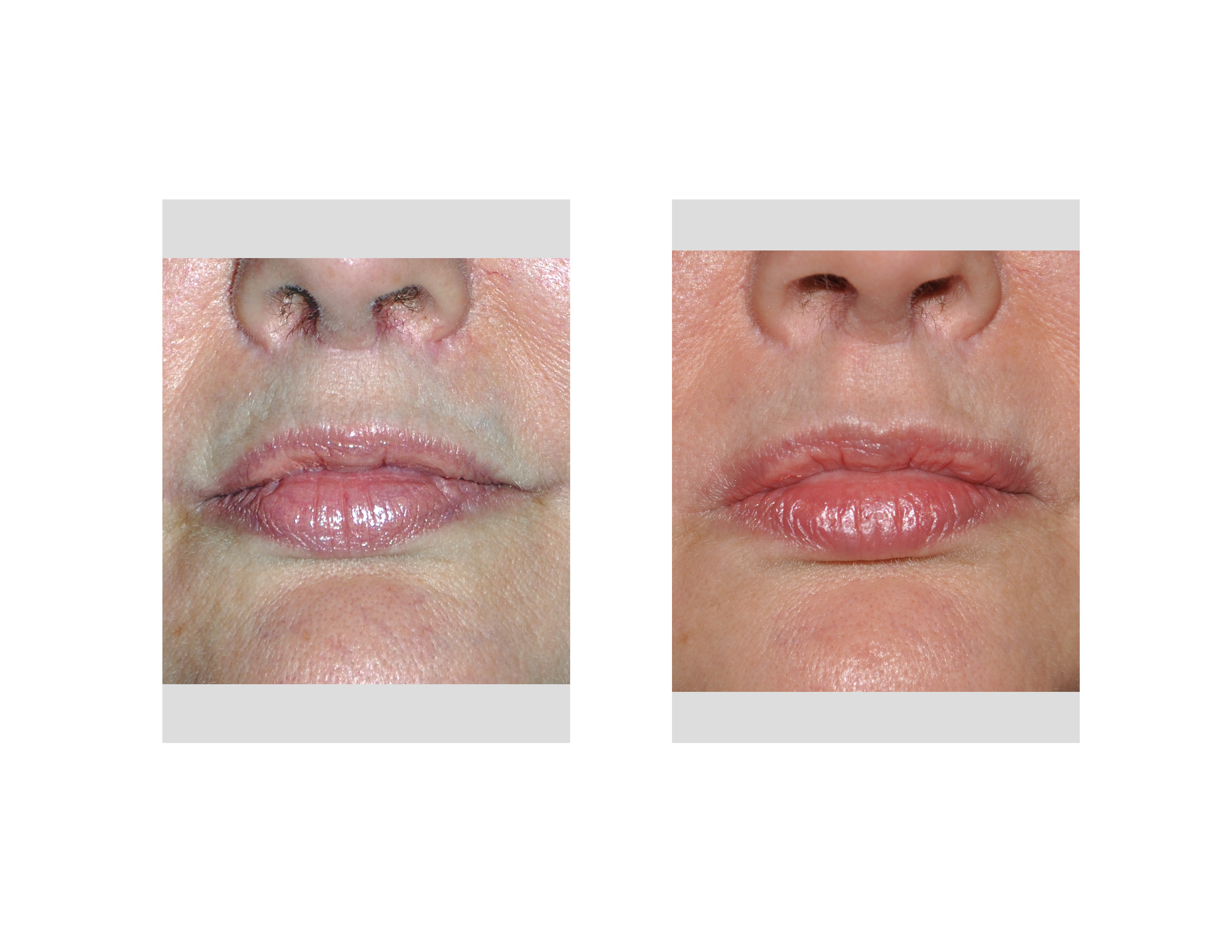 philtral-enhancement-upper-lip-front-view-dr-barry-eppley-indianapolis.jpg