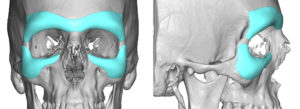 Custom-brow-bone-and-infraorbital-rim-implants-Dr-Barry-Eppley-Indianapolis-300x109.jpg