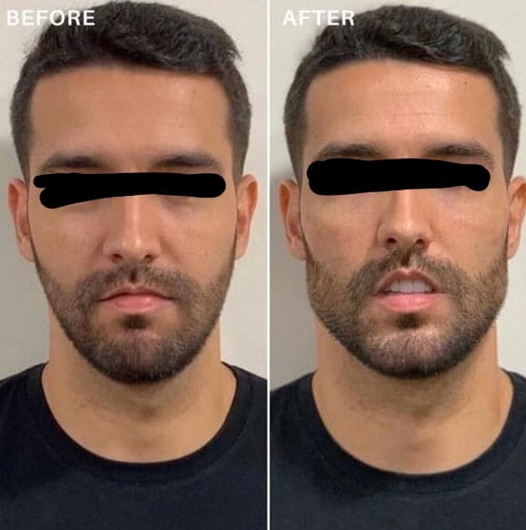 How jawline fillers can helpfinal