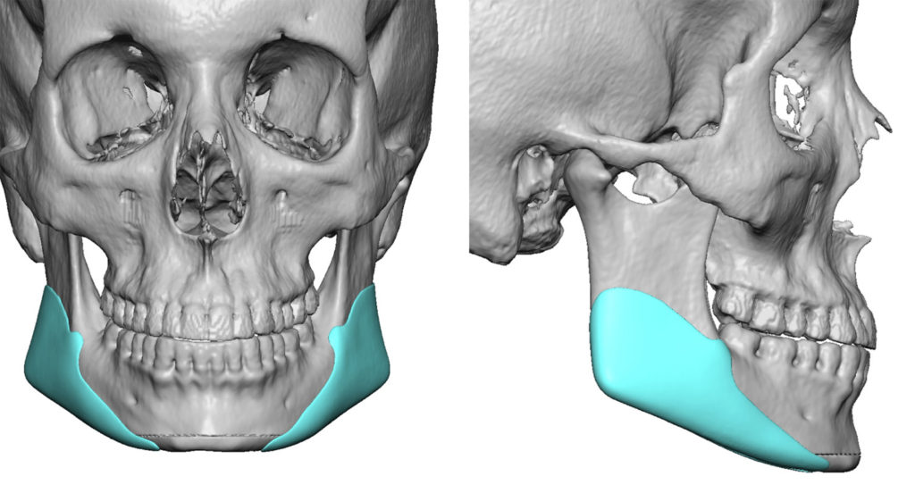 4-Custom-Jaw-Angle-Implants-design-with-oncurrent-vertical-chin-reduction-Dr-Barry-Eppley-Indianapolis-1024x552.jpg
